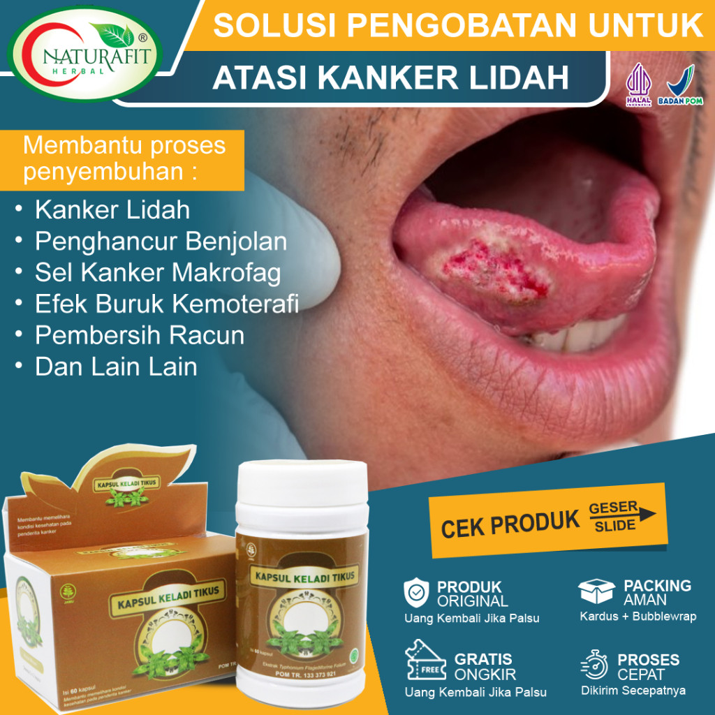 Obat Kanker Lidah Paling Ampuh, Tumor Lidah, Kandidiasis, Kangker Kelenjar Air Ludah, Benjolan Kanker Di Lidah, Kanker Lidah Mulut, Orofaring Karsinoma Sel Skuamosa, Kista Lidah, Kanker Hipofaring Tanpa Operasi - Kapsul Keladi Tikus