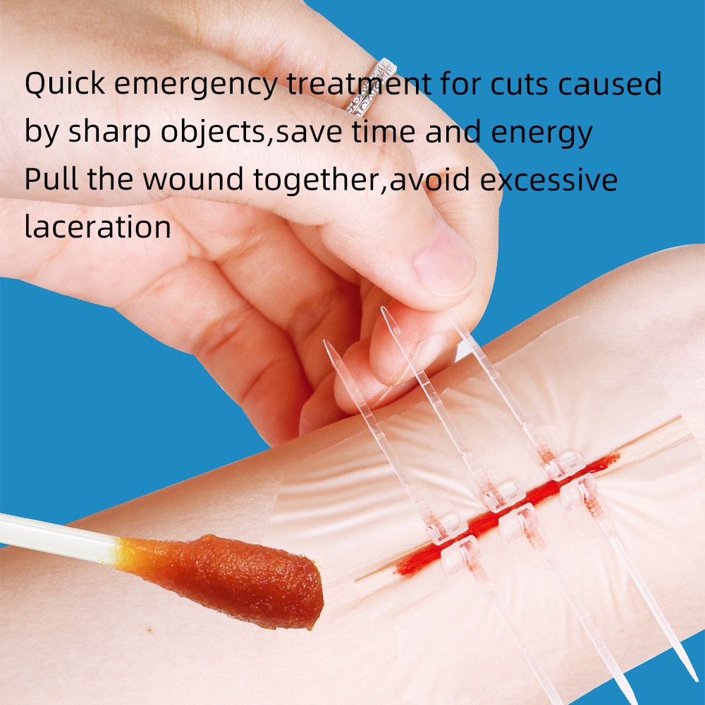 Jual Zipper Band-Aid Wound Closure Device Wound Tie Emergency Repair ...
