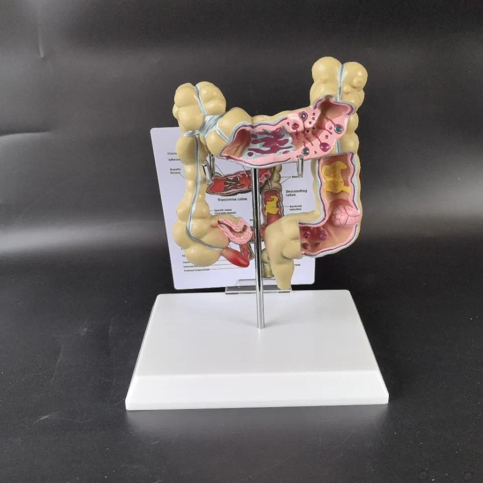 Jual Human colon pathology teaching model, mecal clear anatomy model of ...