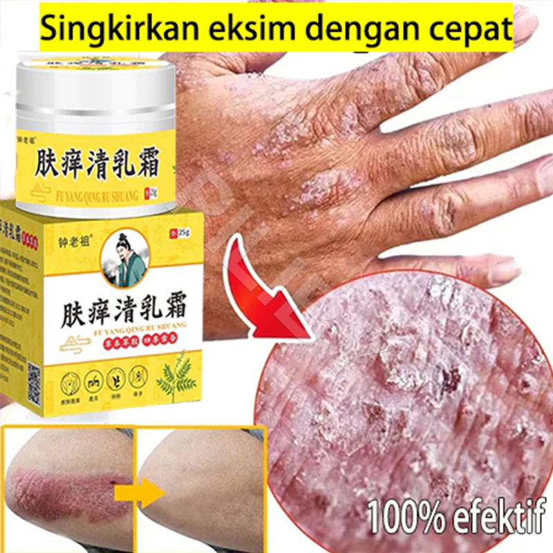 salep gatal paling ampuh Untuk Kulit Iritasi obat eksim psoriasis cream Salep gatal selangkangan Ampuh Atas Psoriasis,Dermatitis,Eksim