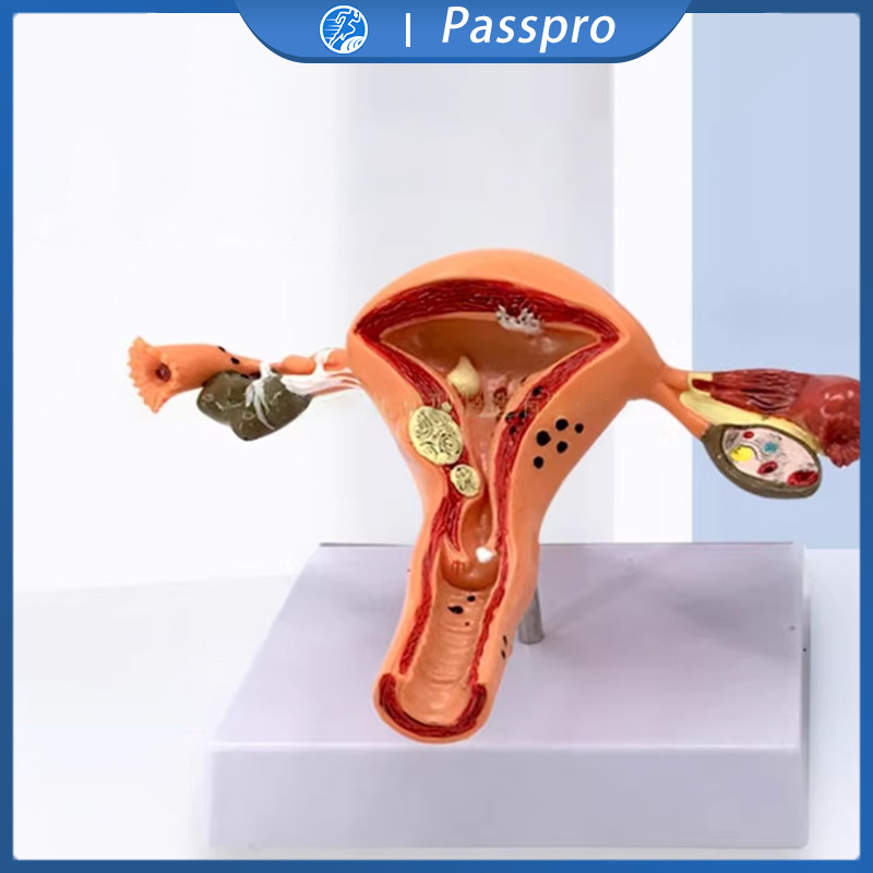 Jual Uterus Anatomical Model 1set Model Lesi Rahim Patologis Uterus ...