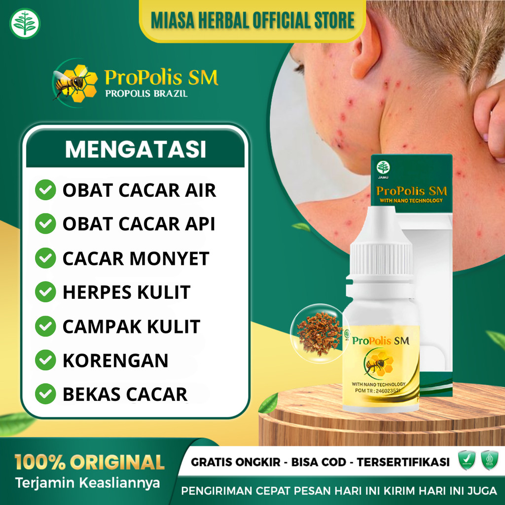 Obat Cacar Anak dan Dewasa Obat Cacar Air Herpes Campak Penghilang Bekas Cacar - Propolis SM Original