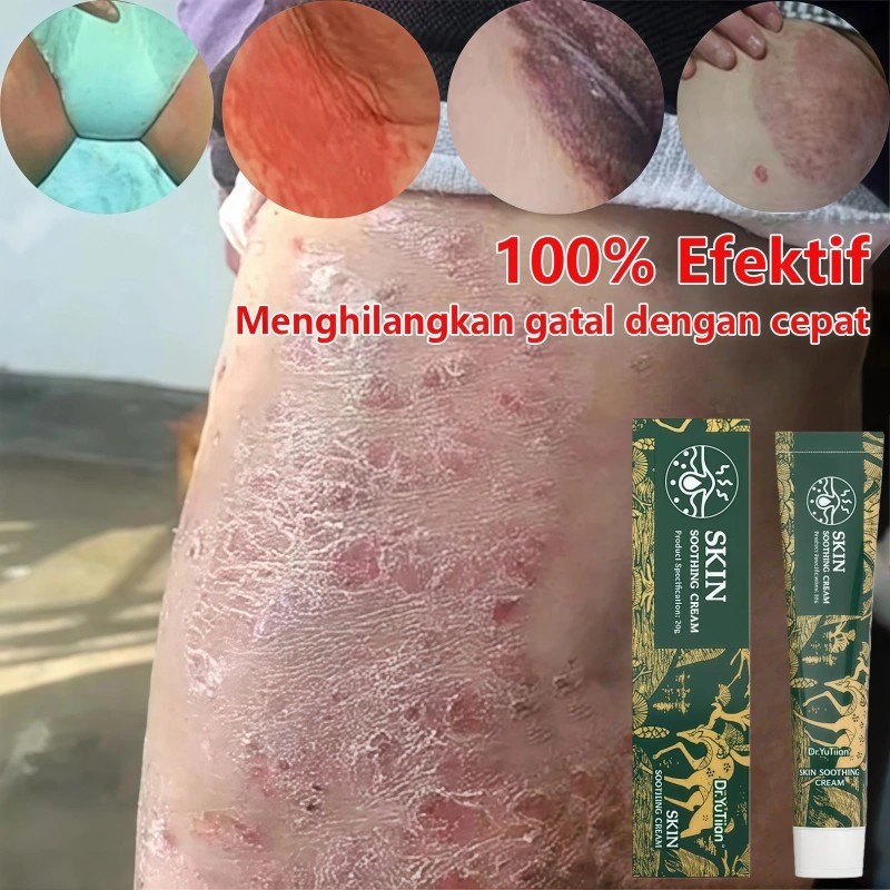 Jual Antibacterial Cream Anti Itching Relief Skin Rash Ointment Eczema ...