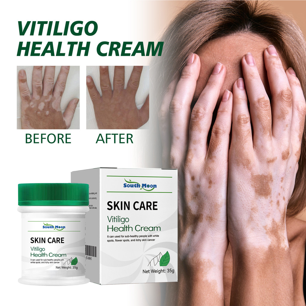 Jual Vitiligo Health Cream Salep Herbal Vitiligo Obat Kulit Vitiligo ...