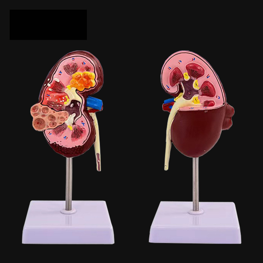 Jual BEST SELLER Two-Sided Kidney Pathologies Model Human Body Anatomy ...