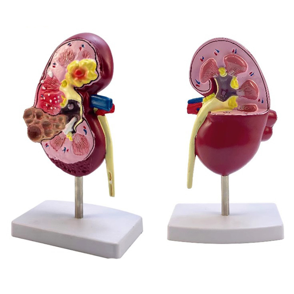 Jual BEST SELLER Normal and Pathology Kidney Anatomical Model Diseased ...