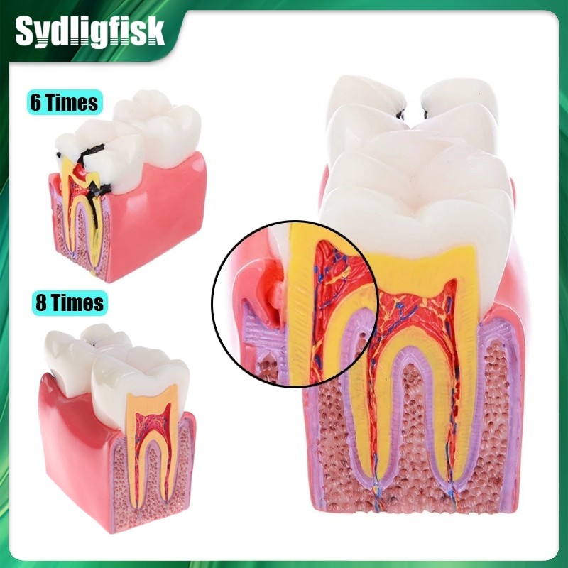 Jual BEST SELLER 8/6Times Dental Caries Teeth Model Comparative Study ...
