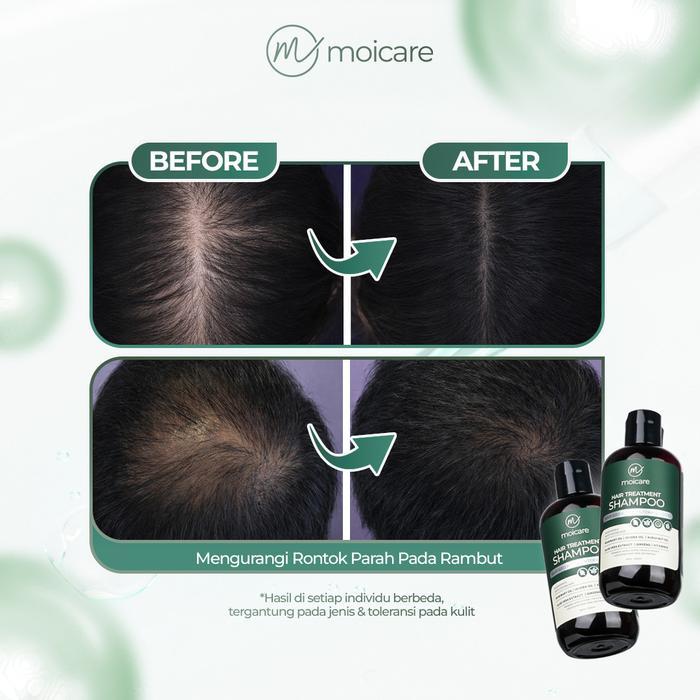Jual Moicare Hair Treatment Shampoo Hair Growth & Anti Hair Loss ...
